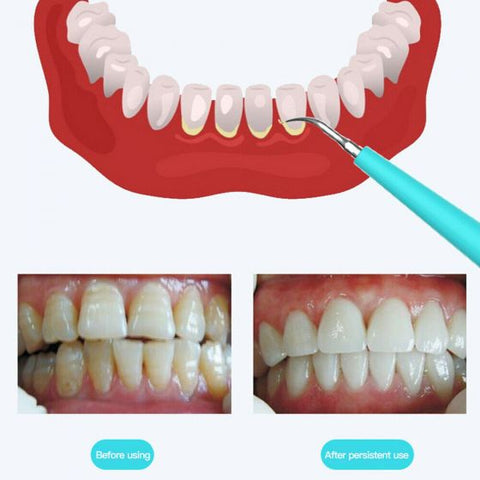 Electric Dental Scaler Tartar Calculus Plaque Remover Tooth Stains Cleaner Tool USB Powered