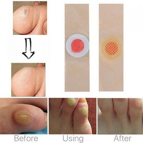 6Pcs Corn Remover Pads