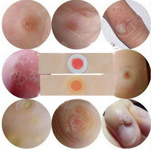 6Pcs Corn Remover Pads